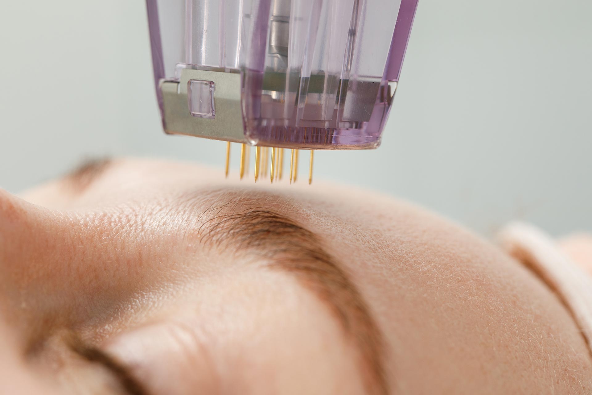 micro-needling Prozedur